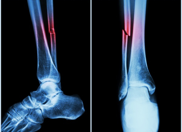 Fracture xray