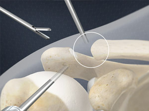 Distal Clavicle Excision (Resection, Arthroscopic Technique) Piedmont ...