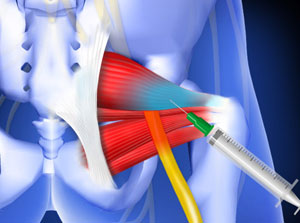 Fluoroscopic Guided Piriformis Injection Piedmont Orthopedics ...