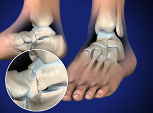 talar neck fracture talar neck fracture