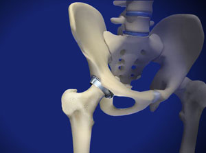 Total Hip Resurfacing Piedmont Orthopedics | OrthoAtlanta