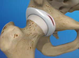 Labral Tear of the Hip (Acetabular Labrum Tear) Piedmont Orthopedics