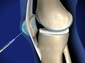 Aspiration Of The Prepatellar Bursa Piedmont Orthopedics OrthoAtlanta Aspiration Of The Prepatellar Bursa Piedmont Orthopedics OrthoAtlanta