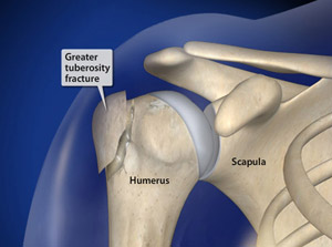 icd 10 code for left humerus greater tuberosity fracture