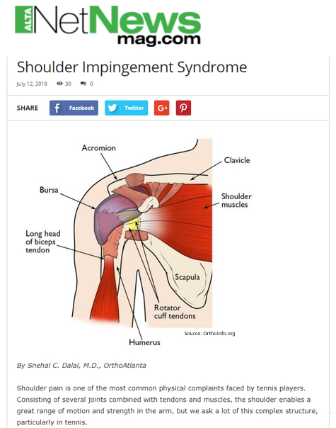 shoulder impingement