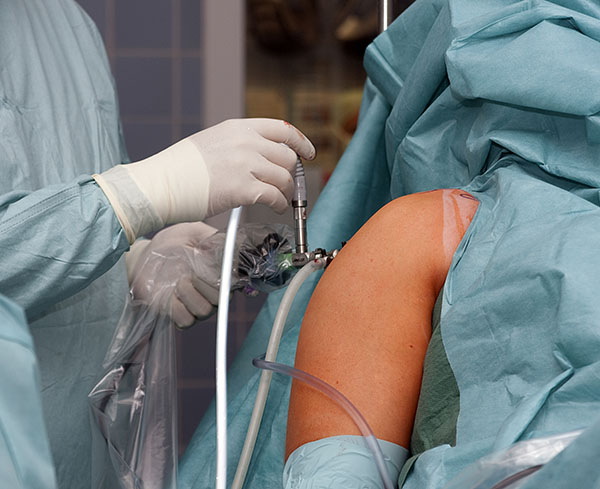 Shoulder Arthroscopy vs Open Surgery: by Comparison