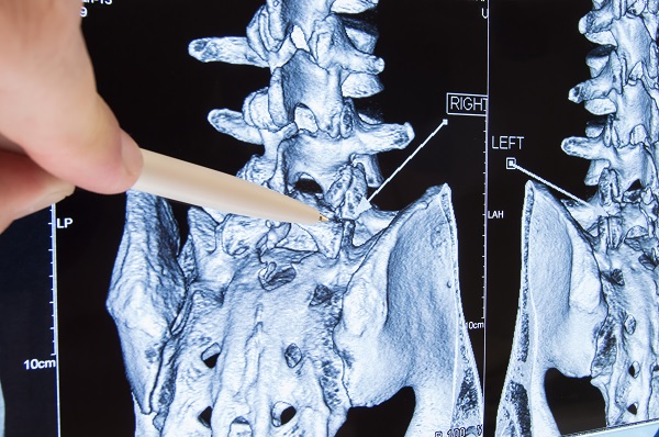 Lumbar Radiculopathy 2