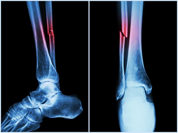 Fracture xray