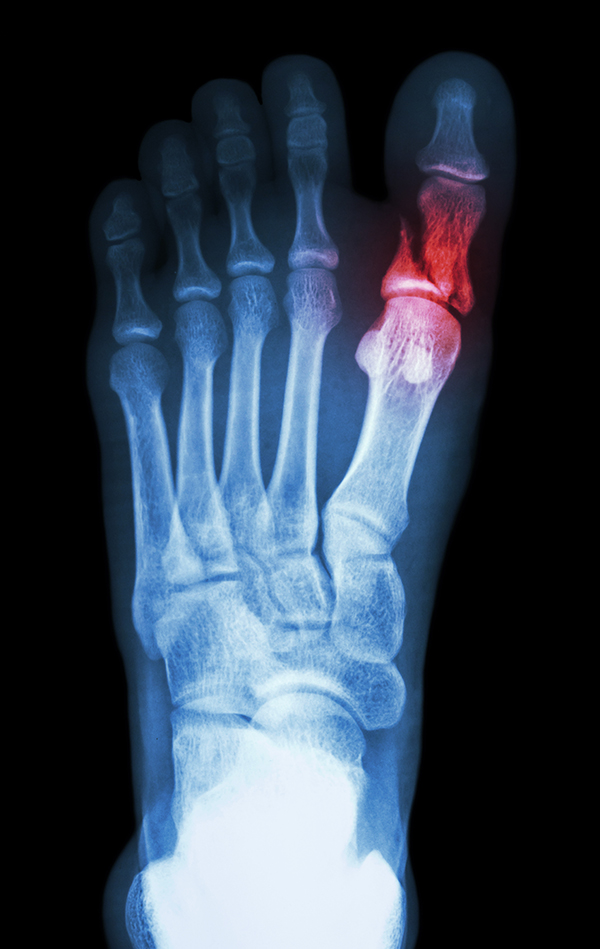 Common Symptoms And Treatment Of A Fractured Toe