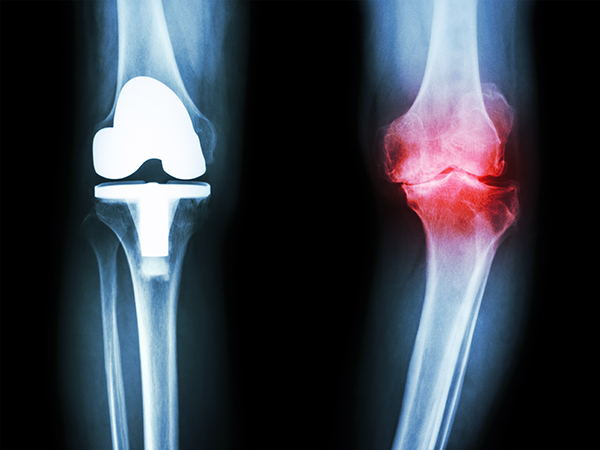 Degenerative Joint Disease in Knee