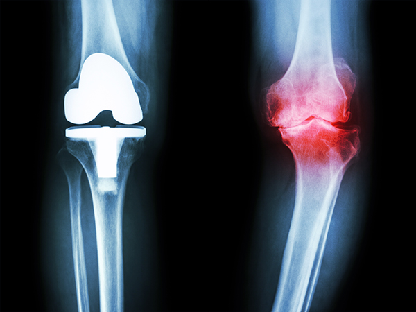 Degenerative Joint Disease in Knee Degenerative Joint Disease in Knee