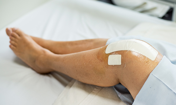 How to Elevate the Leg After Knee Replacement 